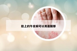 臉上的牛皮癬可以用面膜那