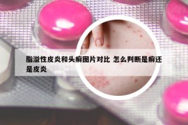 脂溢性皮炎和頭癬圖片對(duì)比 怎么判斷是癬還是皮炎