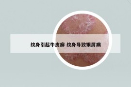 紋身引起牛皮癬 紋身導致銀屑病