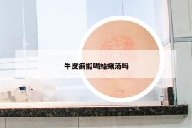 牛皮癬能喝蛤蜊湯嗎