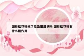 國珍松花粉吃了能治銀屑病嗎 國珍松花粉有什么副作用