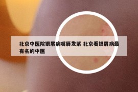 北京中醫(yī)院銀屑病嘴唇發(fā)紫 北京看銀屑病最有名的中醫(yī)