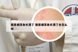 銀屑病渾身長滿了 銀屑病渾身長滿了會怎么樣