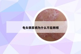 龜頭銀屑病為什么不能斷根