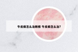 牛皮癬怎么治斷根 牛皮癬怎么治?