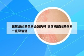 銀屑病的黑色素會(huì)消失嗎 銀屑病留的黑色素一直沒消退