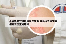 蕁麻疹導致銀屑病復發(fā)加重 蕁麻疹導致銀屑病復發(fā)加重的原因