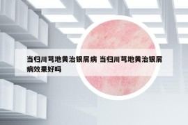 當歸川芎地黃治銀屑病 當歸川芎地黃治銀屑病效果好嗎