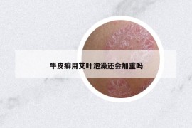 牛皮癬用艾葉泡澡還會(huì)加重嗎