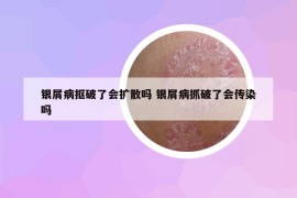 銀屑病摳破了會擴散嗎 銀屑病抓破了會傳染嗎
