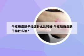 牛皮癬皮膚干燥涂什么比較好 牛皮膚癬皮膚干抹什么油?