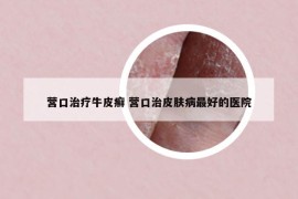 營(yíng)口治療牛皮癬 營(yíng)口治皮膚病最好的醫(yī)院