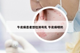 牛皮癬患者想檢測母乳 牛皮癬喂奶