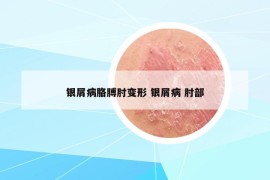 銀屑病胳膊肘變形 銀屑病 肘部