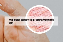 蘭州看銀屑病醫(yī)院在哪里 銀屑病蘭州哪里看的好