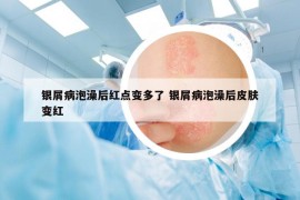 銀屑病泡澡后紅點變多了 銀屑病泡澡后皮膚變紅