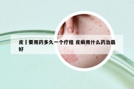 皮廯要用藥多久一個(gè)療程 皮癬用什么藥治最好