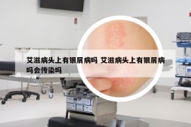 艾滋病頭上有銀屑病嗎 艾滋病頭上有銀屑病嗎會傳染嗎
