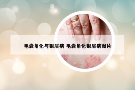 毛囊角化與銀屑病 毛囊角化銀屑病圖片