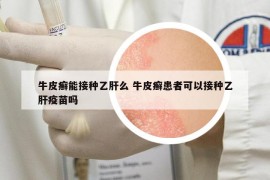 牛皮癬能接種乙肝么 牛皮癬患者可以接種乙肝疫苗嗎