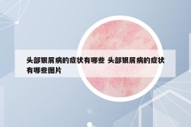 頭部銀屑病的癥狀有哪些 頭部銀屑病的癥狀有哪些圖片