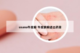 usana牛皮癬 牛皮膚癬進(jìn)口藥膏