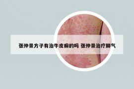 張仲景方子有治牛皮癬的嗎 張仲景治療腳氣