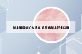 腿上銀屑病擴(kuò)大泛紅 銀屑病腿上好多紅斑