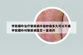 甲氨蝶呤治療銀屑病手指腫痛多久可以不痛 甲氨蝶呤對銀屑病是否一直用藥