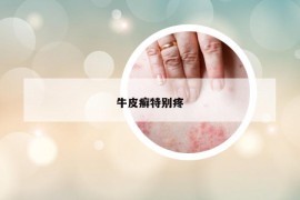 牛皮癬特別疼