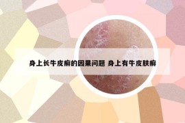 身上長(zhǎng)牛皮癬的因果問題 身上有牛皮膚癬