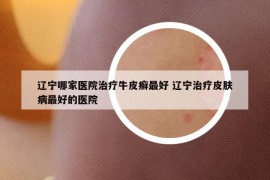 遼寧哪家醫(yī)院治療牛皮癬最好 遼寧治療皮膚病最好的醫(yī)院
