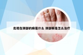 出現(xiàn)在頸部的癬是什么 頸部癬是怎么治療
