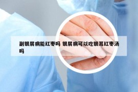 副銀屑病能紅棗嗎 銀屑病可以吃銀耳紅棗湯嗎