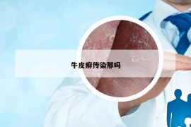 牛皮癬傳染那嗎