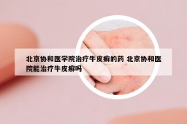 北京協(xié)和醫(yī)學(xué)院治療牛皮癬的藥 北京協(xié)和醫(yī)院能治療牛皮癬嗎