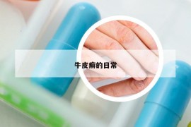 牛皮癬的日常