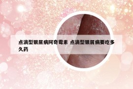 點(diǎn)滴型銀屑病阿奇霉素 點(diǎn)滴型銀屑病要吃多久藥