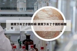腋窩下長(zhǎng)了個(gè)圓形癬 腋窩下長(zhǎng)了個(gè)圓形癬圖片