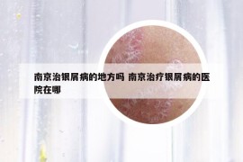 南京治銀屑病的地方嗎 南京治療銀屑病的醫(yī)院在哪
