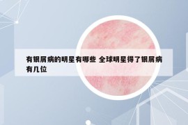 有銀屑病的明星有哪些 全球明星得了銀屑病有幾位