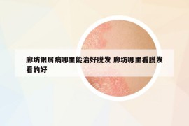 廊坊銀屑病哪里能治好脫發(fā) 廊坊哪里看脫發(fā)看的好