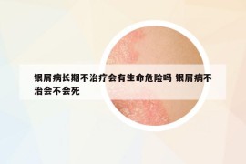 銀屑病長期不治療會有生命危險(xiǎn)嗎 銀屑病不治會不會死