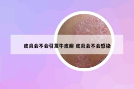皮炎會(huì)不會(huì)引發(fā)牛皮癬 皮炎會(huì)不會(huì)感染