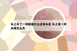 頭上長了一塊癬是什么還有頭皮 頭上有一塊頭癬怎么辦