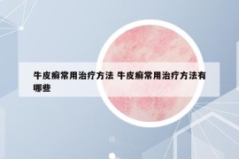 牛皮癬常用治療方法 牛皮癬常用治療方法有哪些