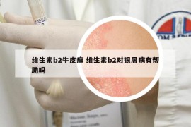 維生素b2牛皮癬 維生素b2對銀屑病有幫助嗎