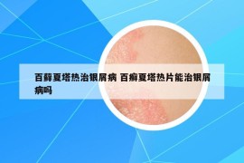 百蘚夏塔熱治銀屑病 百癬夏塔熱片能治銀屑病嗎