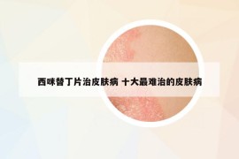 西咪替丁片治皮膚病 十大最難治的皮膚病