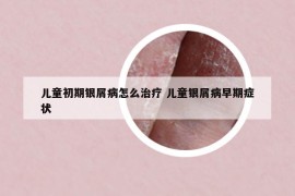 兒童初期銀屑病怎么治療 兒童銀屑病早期癥狀